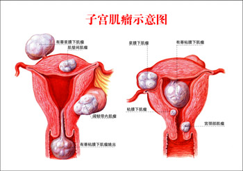 北京试管婴儿公司_双胞胎可以做试管婴儿吗子宫肌瘤的试管婴儿方法有哪些？